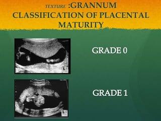 TEXTURE :GRANNUM
CLASSIFICATION OF PLACENTAL
MATURITY
 