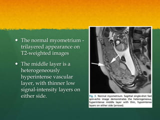  The normal myometrium -
trilayered appearance on
T2-weighted images
 The middle layer is a
heterogeneously
hyperintense vascular
layer, with thinner low
signal-intensity layers on
either side.
 
