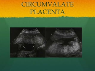 CIRCUMVALATE
PLACENTA
 