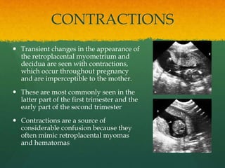 CONTRACTIONS
 Transient changes in the appearance of
the retroplacental myometrium and
decidua are seen with contractions,
which occur throughout pregnancy
and are imperceptible to the mother.
 These are most commonly seen in the
latter part of the first trimester and the
early part of the second trimester
 Contractions are a source of
considerable confusion because they
often mimic retroplacental myomas
and hematomas
 