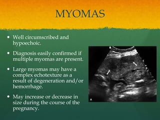 MYOMAS
 Well circumscribed and
hypoechoic.
 Diagnosis easily confirmed if
multiple myomas are present.
 Large myomas may have a
complex echotexture as a
result of degeneration and/or
hemorrhage.
 May increase or decrease in
size during the course of the
pregnancy.
 