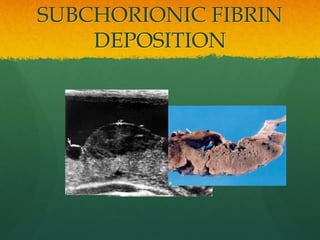 SUBCHORIONIC FIBRIN
DEPOSITION
 