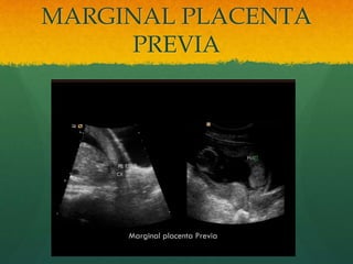 MARGINAL PLACENTA
PREVIA
 