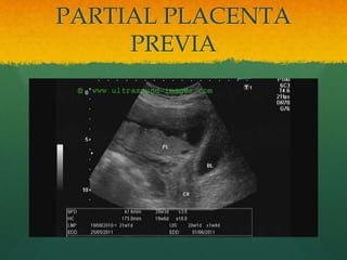 PARTIAL PLACENTA
PREVIA
 
