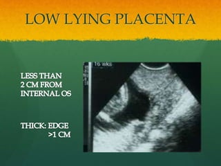 LOW LYING PLACENTA
 