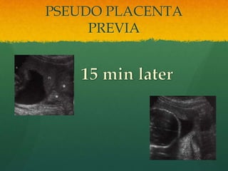 PSEUDO PLACENTA
PREVIA
 