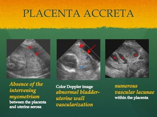 PLACENTA ACCRETA
 