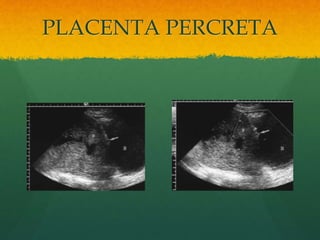 PLACENTA PERCRETA
 