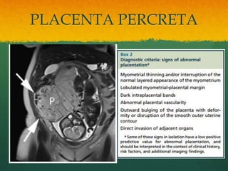 PLACENTA PERCRETA
 