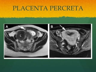 PLACENTA PERCRETA
 