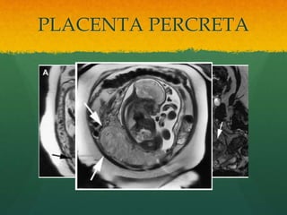 PLACENTA PERCRETA
 