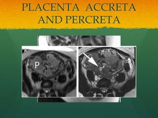 PLACENTA ACCRETA
AND PERCRETA
 