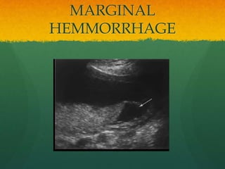 MARGINAL
HEMMORRHAGE
 