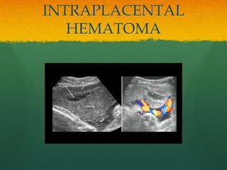 INTRAPLACENTAL
HEMATOMA
 
