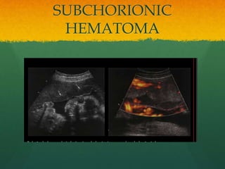 SUBCHORIONIC
HEMATOMA
 
