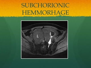 SUBCHORIONIC
HEMMORHAGE
 
