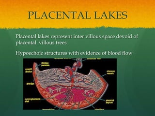PLACENTAL LAKES
Placental lakes represent inter villous space devoid of
placental villous trees
Hypoechoic structures with evidence of blood flow
 