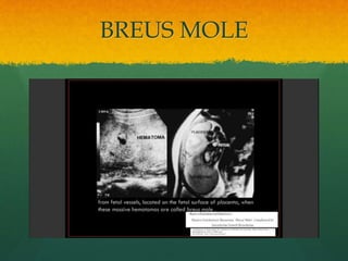 BREUS MOLE
 
