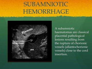 SUBAMNIOTIC
HEMORRHAGE
A subamniotic
haematomas are classical
placental pathological
lesions resulting from
the rupture of chorionic
vessels (allantochorionic
vessels) close to the cord
insertion.
 