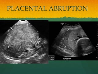 PLACENTAL ABRUPTION
 