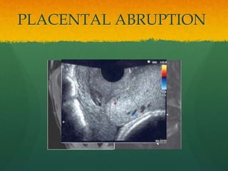PLACENTAL ABRUPTION
 