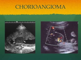 CHORIOANGIOMA
 