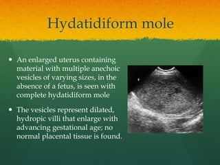Hydatidiform mole
 An enlarged uterus containing
material with multiple anechoic
vesicles of varying sizes, in the
absence of a fetus, is seen with
complete hydatidiform mole
 The vesicles represent dilated,
hydropic villi that enlarge with
advancing gestational age; no
normal placental tissue is found.
 