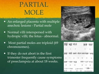 PARTIAL
MOLE
 An enlarged placenta with multiple
anechoic lesions - Partial mole
 Normal villi interspersed with
hydropic villi; the fetus - abnormal.
 Most partial moles are triploid (69
chromosomes).
 If they do not abort in the first
trimester frequently cause symptoms
of preeclampsia at about 18 weeks.
 