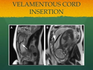 VELAMENTOUS CORD
INSERTION
 