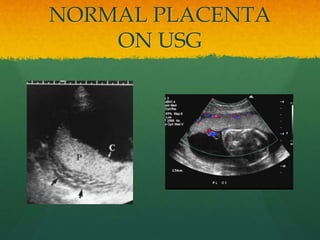 NORMAL PLACENTA
ON USG
 