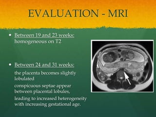 EVALUATION - MRI
 Between 19 and 23 weeks:
homogeneous on T2
 Between 24 and 31 weeks:
the placenta becomes slightly
lob...