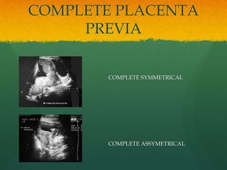 COMPLETE PLACENTA
PREVIA
COMPLETE SYMMETRICAL
COMPLETE ASSYMETRICAL
 