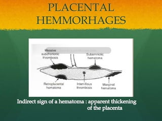 PLACENTAL
HEMMORHAGES
 