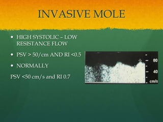 INVASIVE MOLE
 HIGH SYSTOLIC – LOW
RESISTANCE FLOW
 PSV > 50/cm AND RI <0.5
 NORMALLY
PSV <50 cm/s and RI 0.7
 
