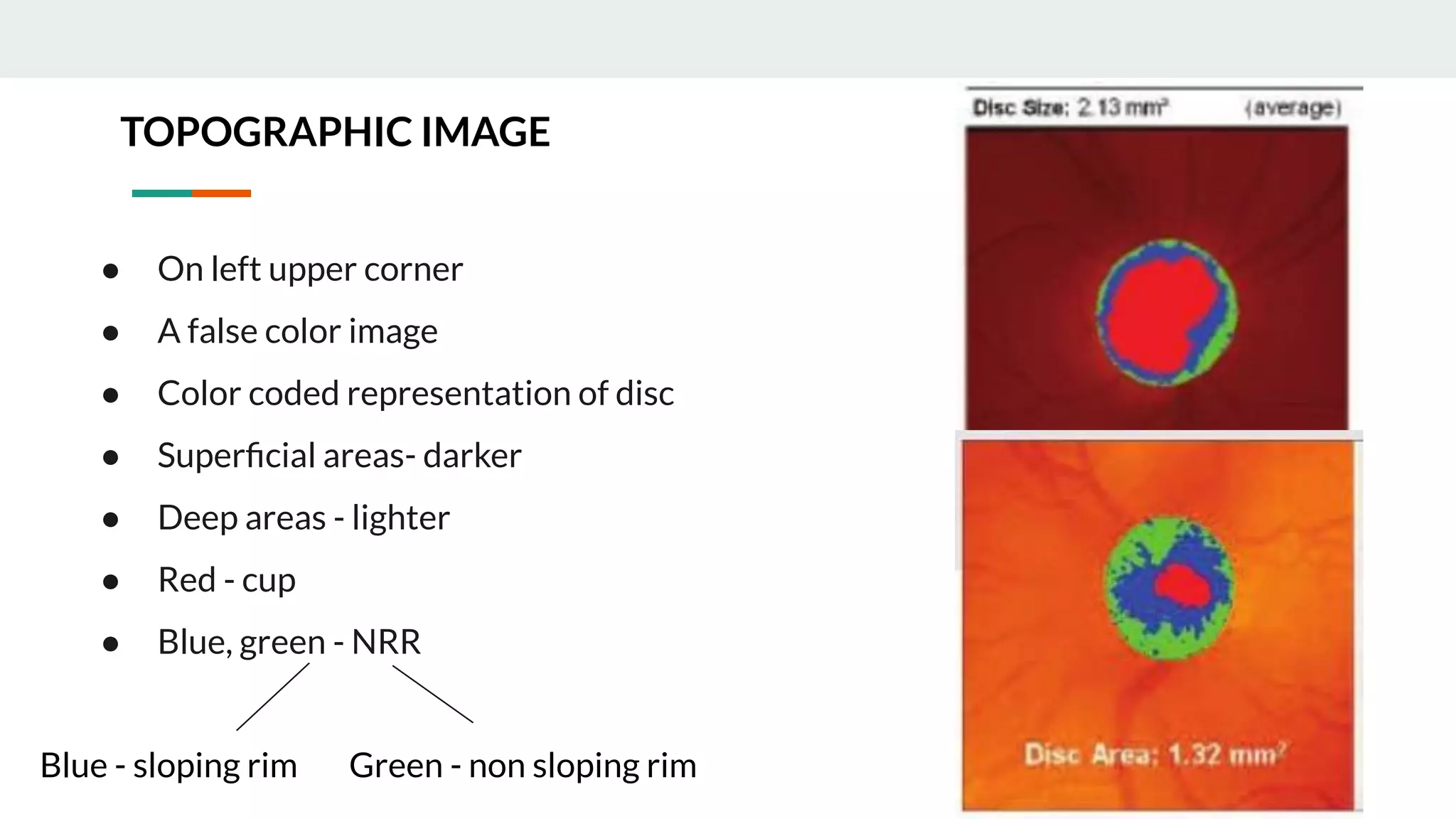 Evaluation of preperimetric glaucoma | PDF