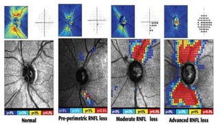 Evaluation of preperimetric glaucoma | PDF