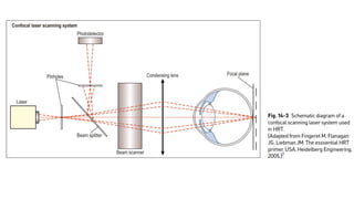 Evaluation of preperimetric glaucoma | PDF