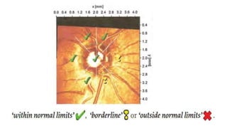 Evaluation of preperimetric glaucoma | PDF