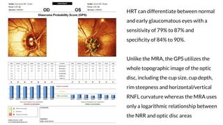 Evaluation of preperimetric glaucoma | PDF