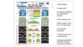 Evaluation of preperimetric glaucoma | PDF