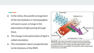 Evaluation of preperimetric glaucoma | PDF