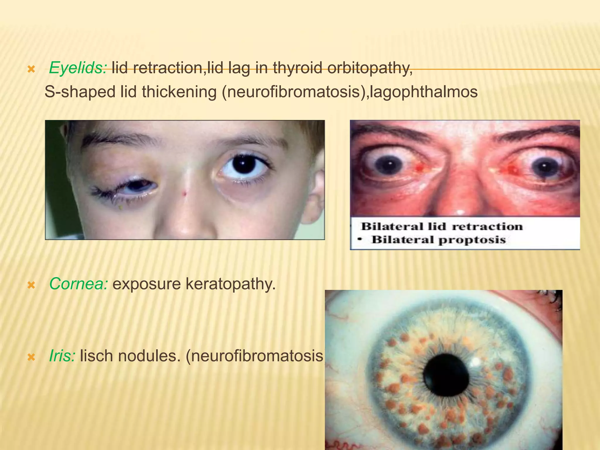 Detailed Proptosis Of Eye Wallpaper Illustration Detailed Proptosis Of Eye Wallpaper Illustration