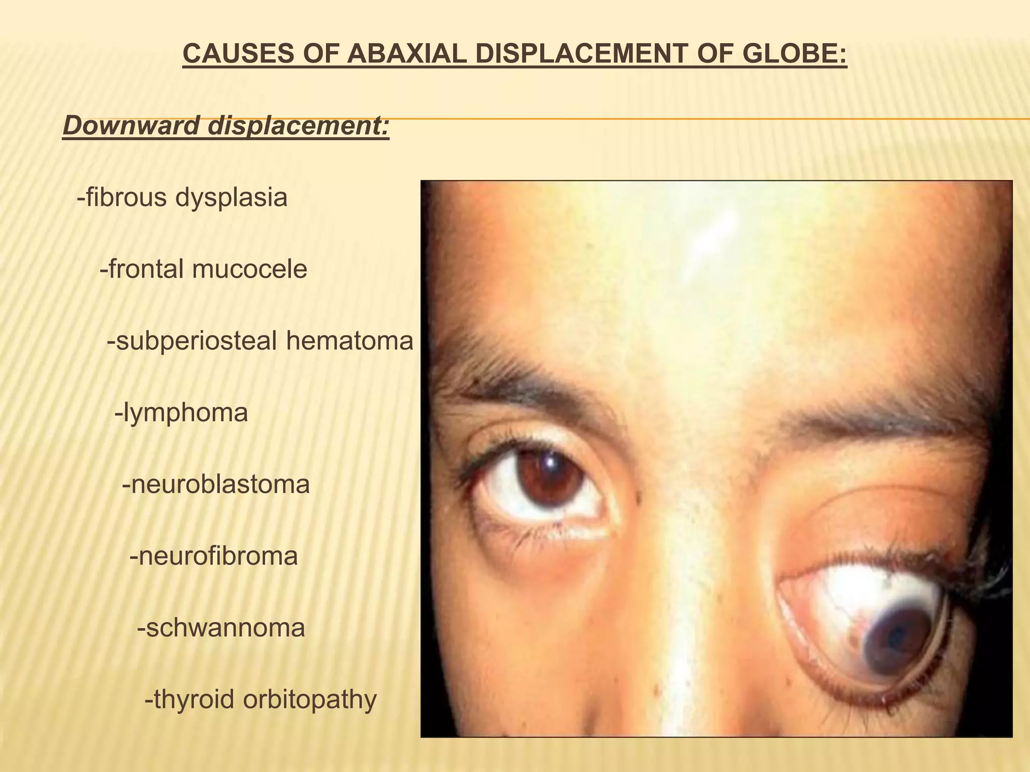 CAUSES OF ABAXIAL DISPLACEMENT OF GLOBE:
Downward displacement:
-fibrous dysplasia
-frontal mucocele
-subperiosteal hematoma
-lymphoma
-neuroblastoma
-neurofibroma
-schwannoma
-thyroid orbitopathy
 