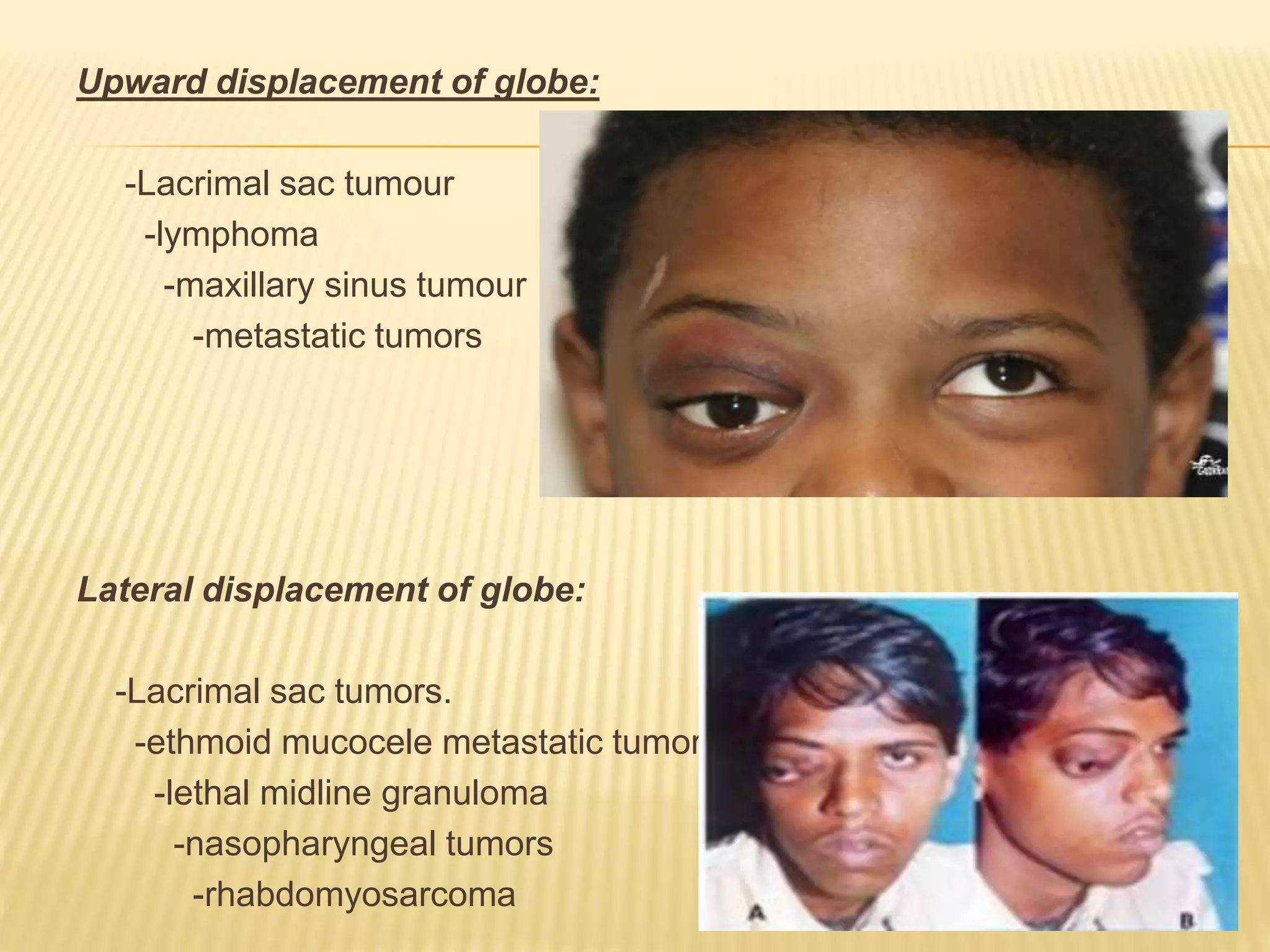 Upward displacement of globe:
-Lacrimal sac tumour
-lymphoma
-maxillary sinus tumour
-metastatic tumors
Lateral displacement of globe:
-Lacrimal sac tumors.
-ethmoid mucocele metastatic tumors
-lethal midline granuloma
-nasopharyngeal tumors
-rhabdomyosarcoma
 
