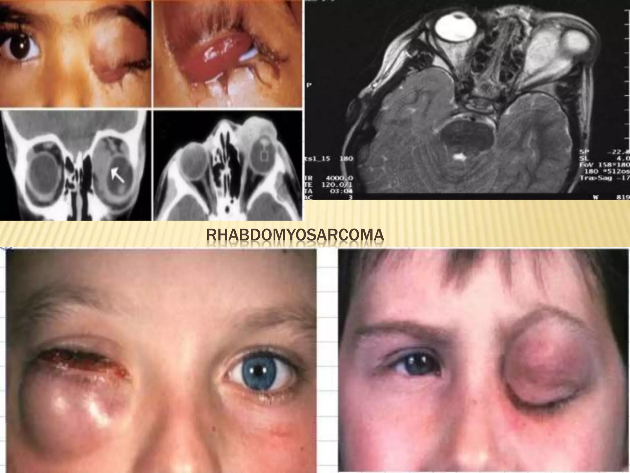 RHABDOMYOSARCOMA
 