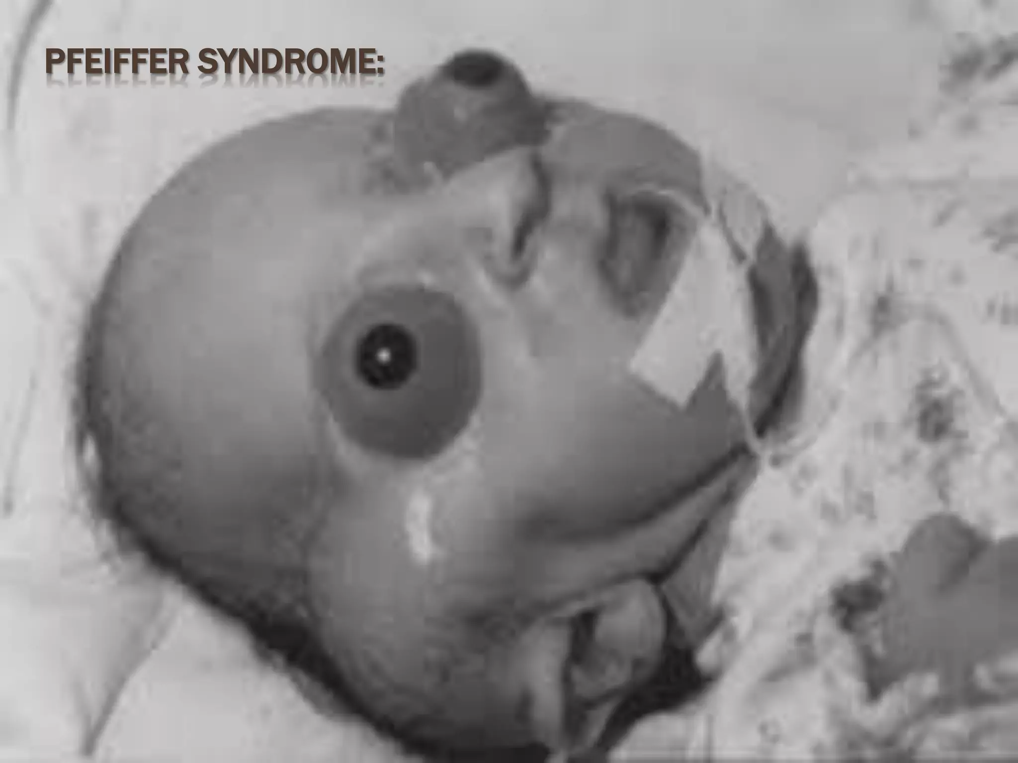PFEIFFER SYNDROME:
 