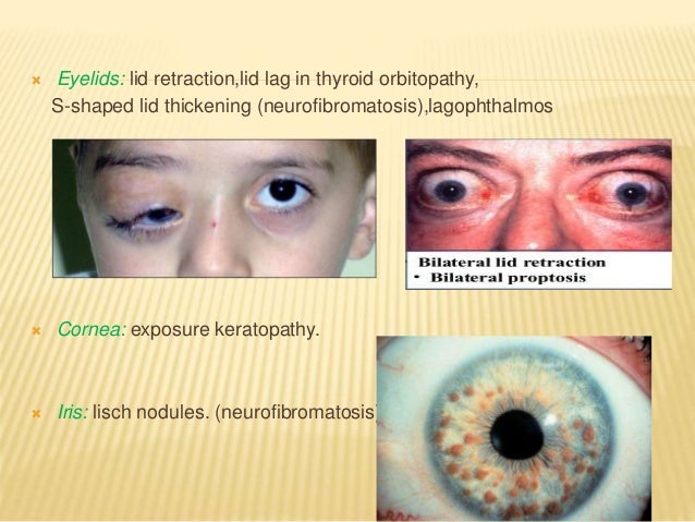 evaluation of proptosis proptosis