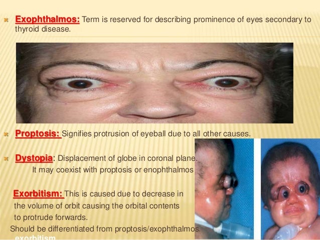evaluation of proptosis proptosis