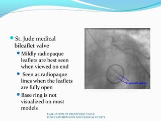St. Jude medical
 bileaflet valve
  Mildly radiopaque
   leaflets are best seen
   when viewed on end
   Seen as radiop...
