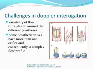 Challenges in doppler interogation
variability of flow
 through and around the
 different prostheses
Some prosthetic val...